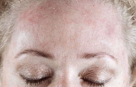 Peut tomber du psoriasis les cheveux