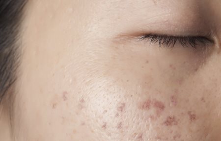 Le ton de la personne aux taches de rousseur