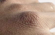 La pastèque peut au psoriasis