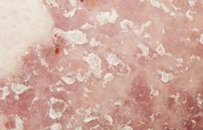 Le médicament traiter leczéma