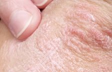 La transmission malychevoj sur le psoriasis
