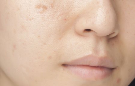 Visage d'une femme à la peau grasse et à imperfections