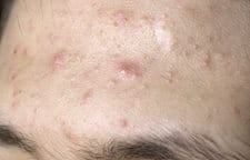 Gros plan sur un front avec des symptômes d'acné