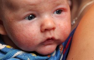 Visage de bébé avec une peau squameuse et sujette aux rougeurs.